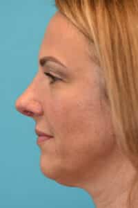 Rhinoplasty (Nose Job) Before and After Photos
