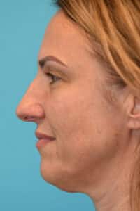 Rhinoplasty (Nose Job) Before and After Photos