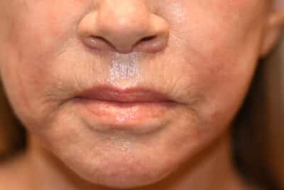 Facelift and Necklift Before and After Photos