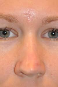 Skin Cancer Reconstruction Before and After Photos