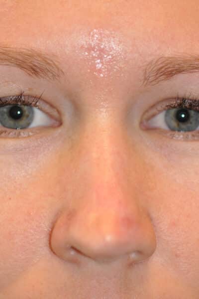 Skin Cancer Reconstruction Before and After Photos