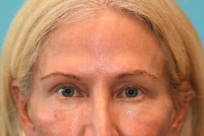 Upper Blepharoplasty (Eyelid) Before and After Photos