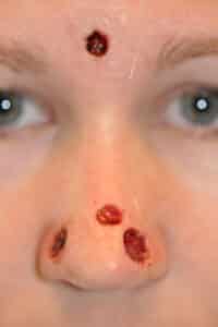 Skin Cancer Reconstruction Before and After Photos