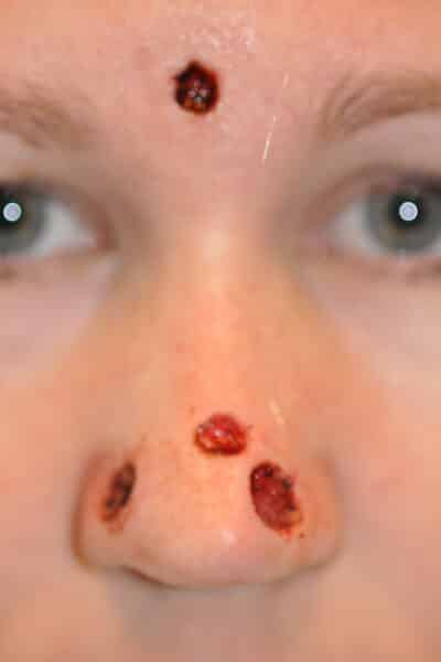 Skin Cancer Reconstruction Before and After Photos