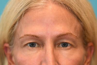 Upper Blepharoplasty (Eyelid) Before and After Photos