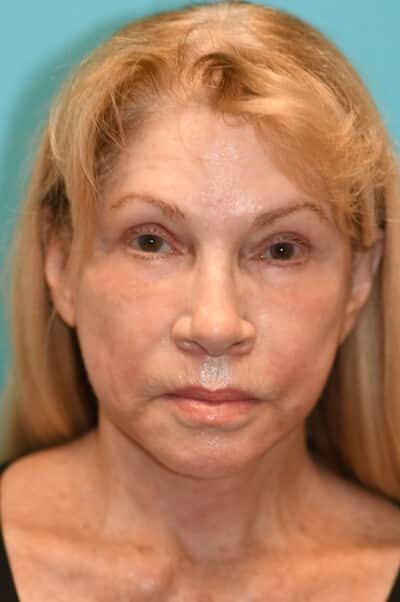 Facelift and Necklift Before and After Photos