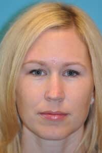 Skin Cancer Reconstruction Before and After Photos
