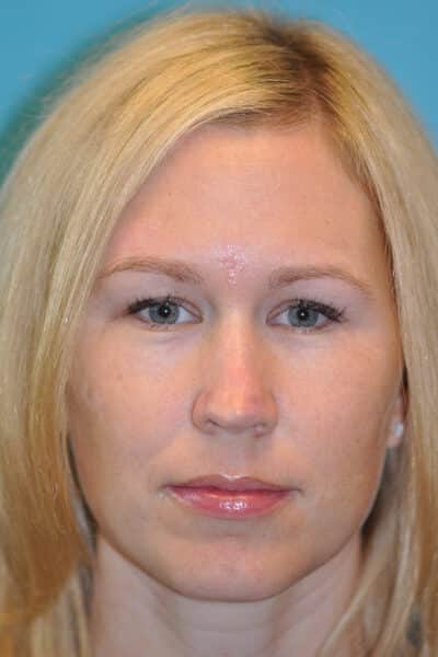 Skin Cancer Reconstruction Before and After Photos