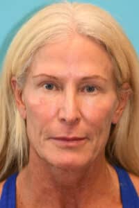 Upper Blepharoplasty (Eyelid) Before and After Photos