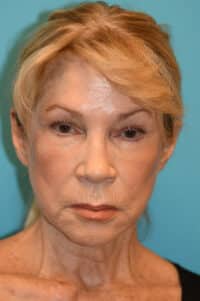 Facelift and Necklift Before and After Photos
