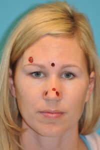 Skin Cancer Reconstruction Before and After Photos
