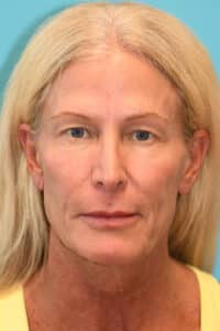 Upper Blepharoplasty (Eyelid) Before and After Photos
