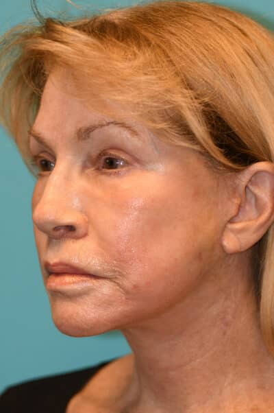 Facelift and Necklift Before and After Photos