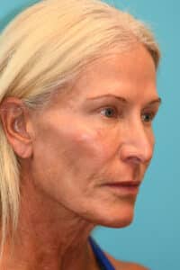 Upper Blepharoplasty (Eyelid) Before and After Photos