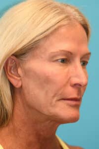 Upper Blepharoplasty (Eyelid) Before and After Photos