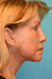 Facelift and Necklift Before and After Photos