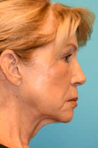 Facelift and Necklift Before and After Photos