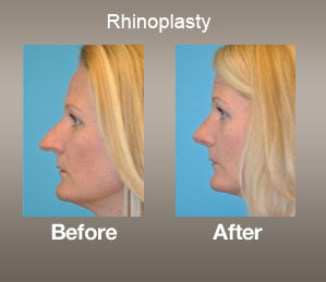 rhinoplasty