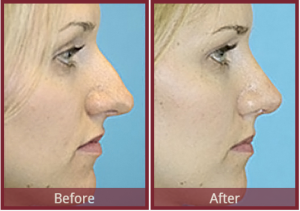 rhinoplasty procedure before and after