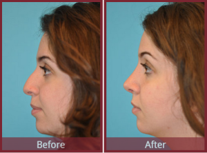 scottsdale rhinoplasty procedure pictures