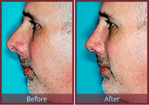 chin implant with rhinoplasty surgery scottsdale