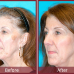 Surgical & Non-Surgical Options for Facial Anti-Aging in Scottsdale
