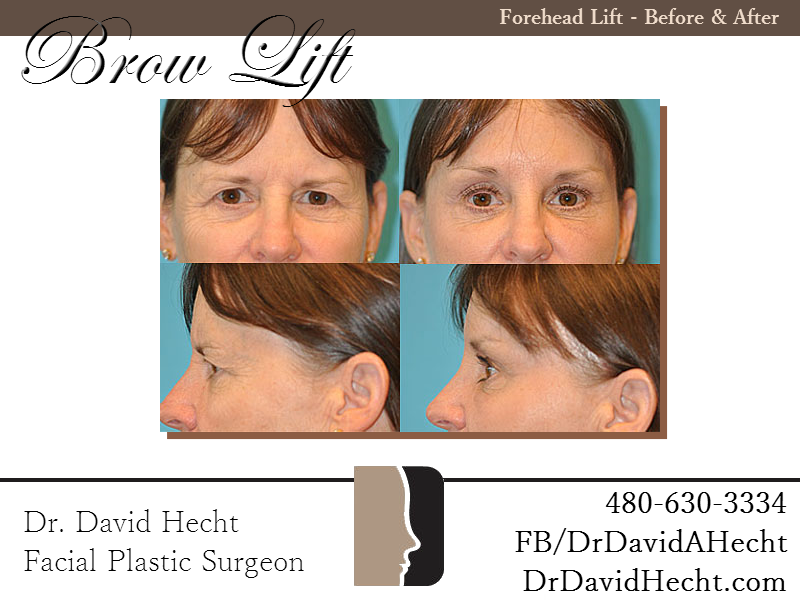 Browlift Results Scottsdale