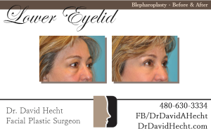 Lower Eyelid Blepharoplasty Results