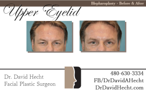 Scottsdale Upper Eyelid Blepharoplasty