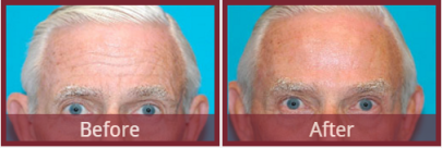 Botox before and after Scottsdale