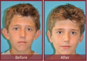 before and after otoplasty faq