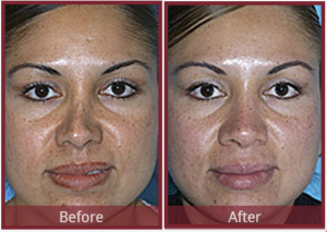 Revision Rhinoplasty Before & After Results Scottsdale