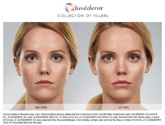 Juvederm XC Scottsdale | Juvederm Voluma | Dermal Fillers ...