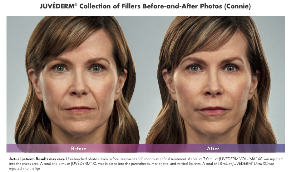 Juvederm Dermal Filler Before and After Photo Scottsdale