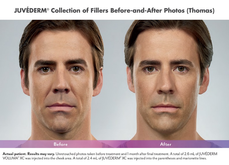 Juvederm Dermal Filler Before and After Photo Scottsdale