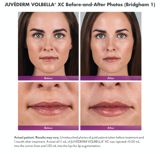 Juvederm Dermal Filler Before and After Photo Scottsdale