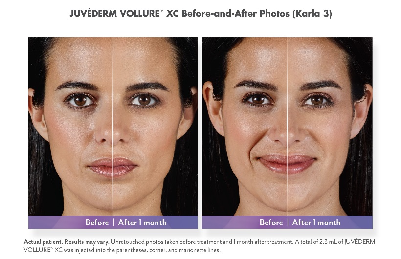 Juvederm Dermal Filler Before and After Photo Scottsdale