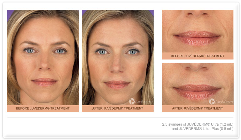 Juvederm Dermal Filler Before and After Photo Scottsdale
