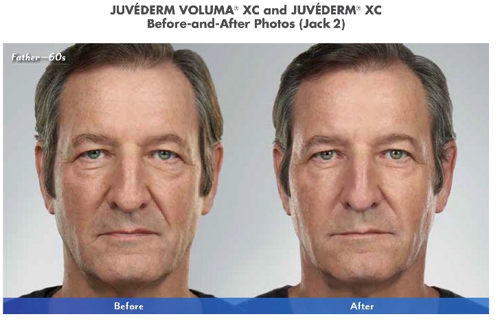Juvederm Dermal Filler Before and After Photo Scottsdale