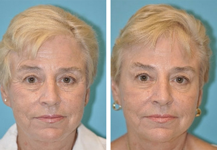 BOTOX Before and After Scottsdale