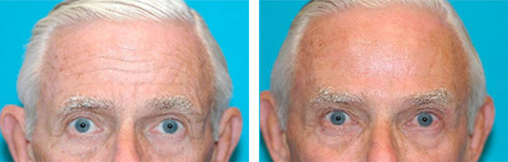 BOTOX Before and After Scottsdale